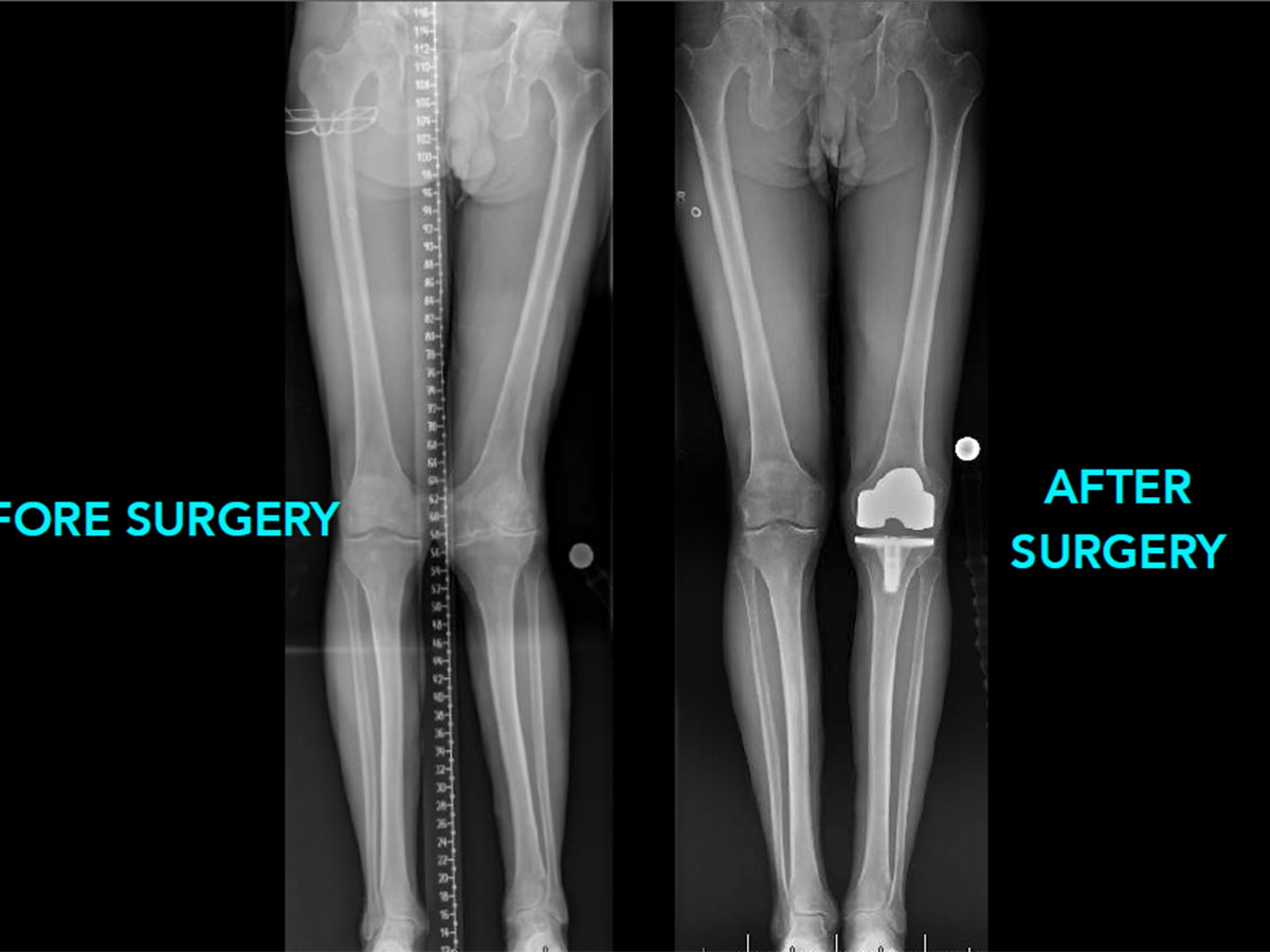 knee arthroplasty
