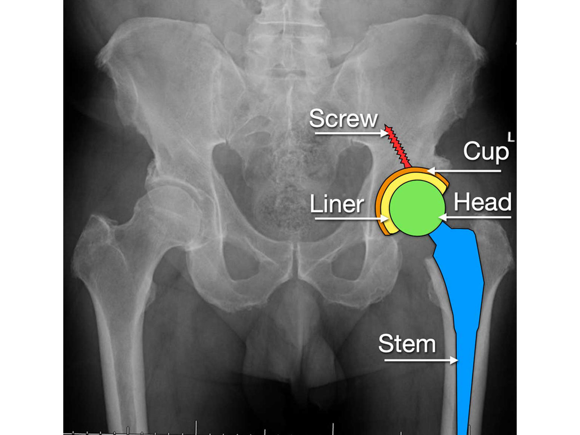 Direct Anterior Hip Arthroplasty – RHK Surgery