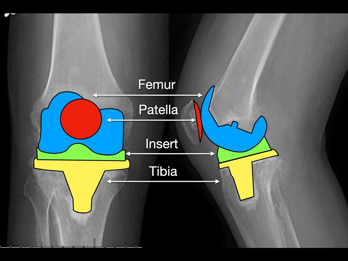 knee-pics.007